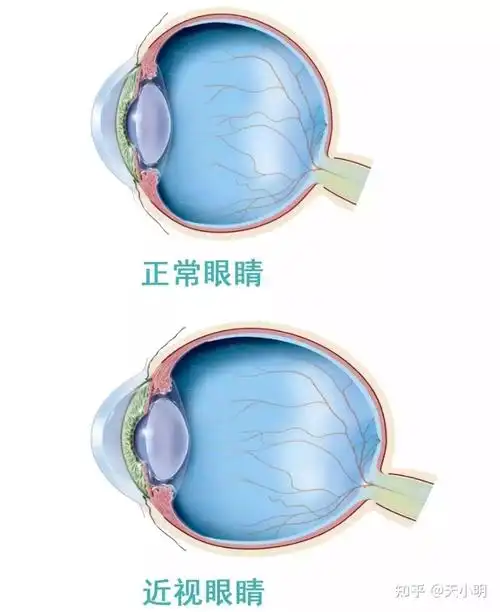 低度近视眼(小于300度)并发症很少,而高度近视者(大于600度)其眼球