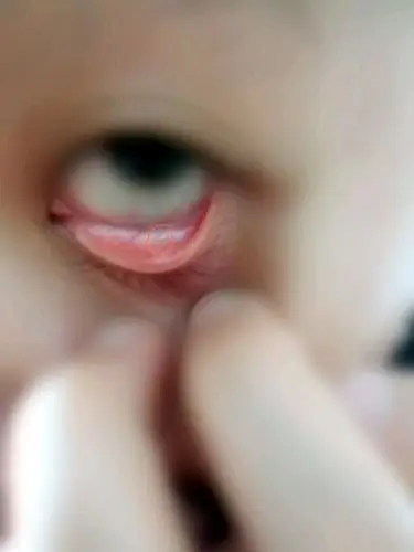 下眼皮内有白点