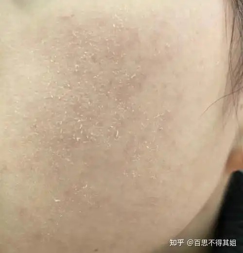 皮肤缺水怎么补水