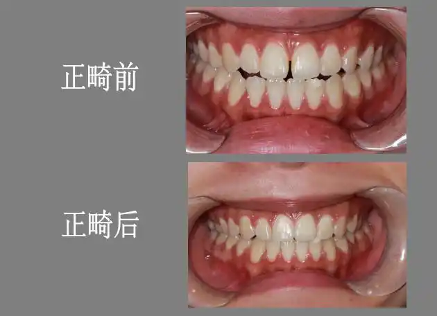 4,对口腔健康有害:稀疏的牙齿常常咬合不正常,容易引起异常,使面部