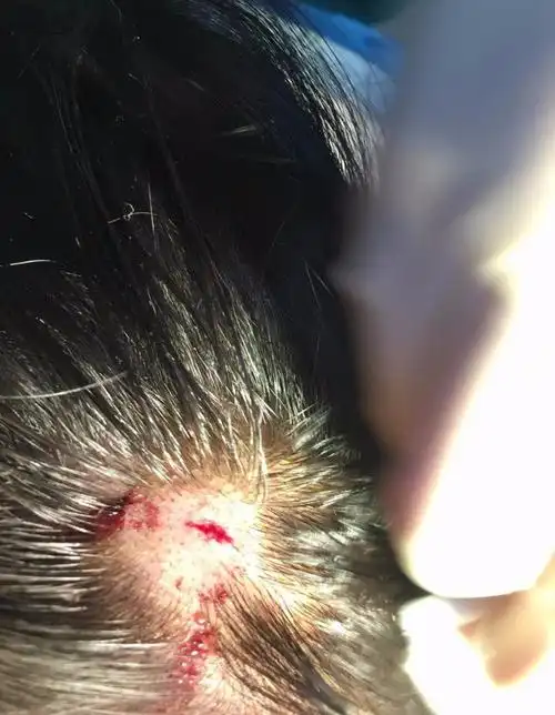 有媒体求证后获悉,黄灿灿受伤属实,头部伤口直径约一厘米,为了不影响