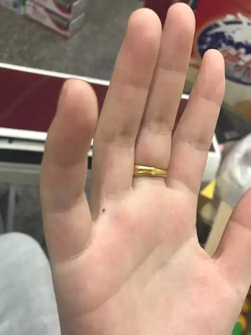 无名指与小指中间最近几个月才发现长了一个痣,之前很小 现在大了