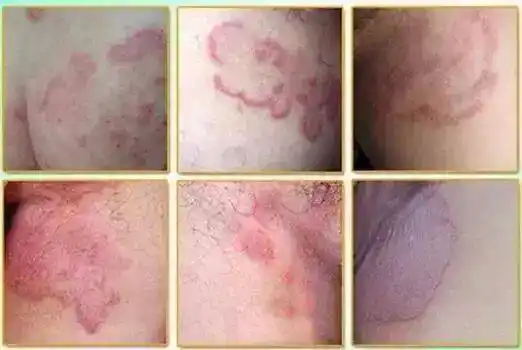 真菌性皮肤病:由各种癣菌感染引起的浅部真菌病几乎都可通过接触传播