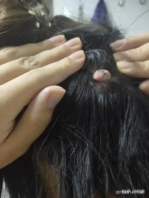 后脑勺长了一个肉疙瘩