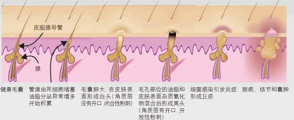 按照病理学痘痘分为/6类:首先我们要了解一下形成痘痘的原因有哪些?