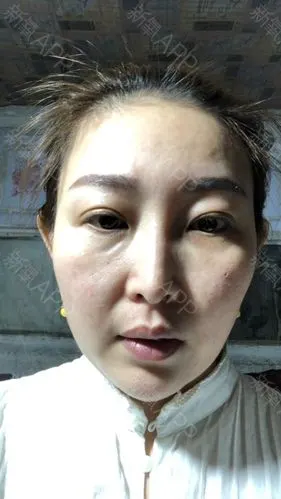 氧气zv2so玻尿酸丰泪沟术后第3天美丽日记_新氧整形