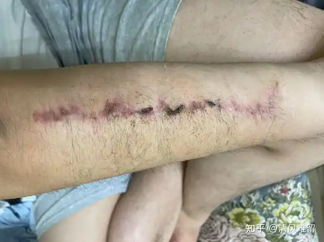 20厘米纹身切除及恢复日记3