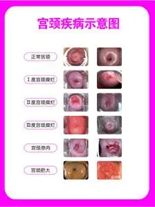 751海报印制展板写真喷绘470医院健康知识妇科挂图宫颈疾病示意图