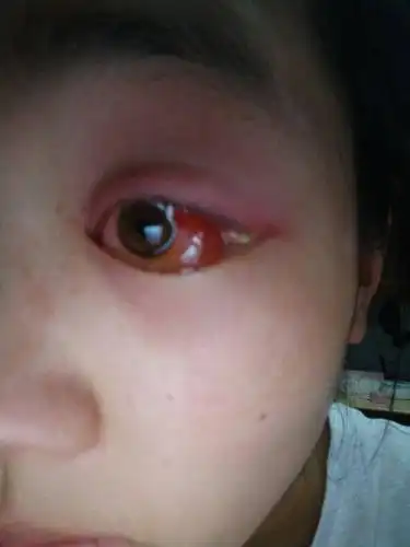 医生说我得了结膜炎.