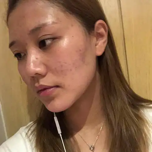 为什么熬夜就长痘【昆明美莱】