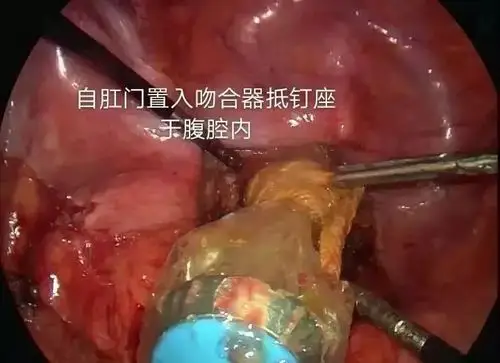 标本取出固定抵钉座,备吻合用吻合后效果显露清扫淋巴结后情况腹部