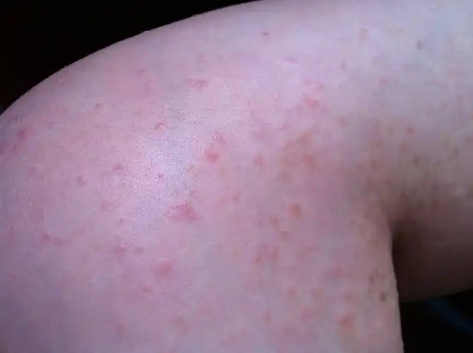 长春肤康医院浅谈:亚急性湿疹的发病特点