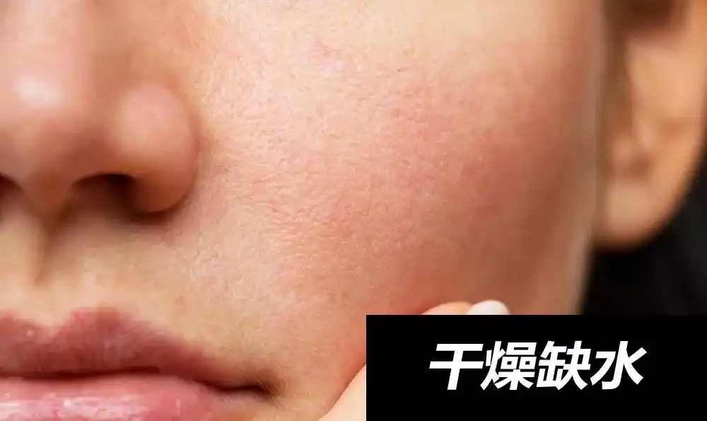 干燥缺水:皮肤肉眼可见的干燥,干纹小细纹明显,严重的甚至会起皮屑