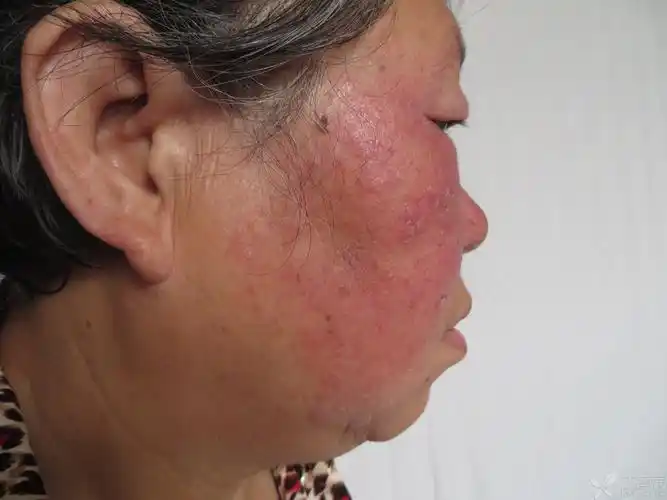 【请教】中药洗出来的面部接触性皮炎?