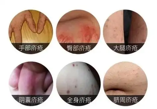 长沙皮肤病医院_疥疮是怎么引起的?初期症状有哪些?会传染吗?