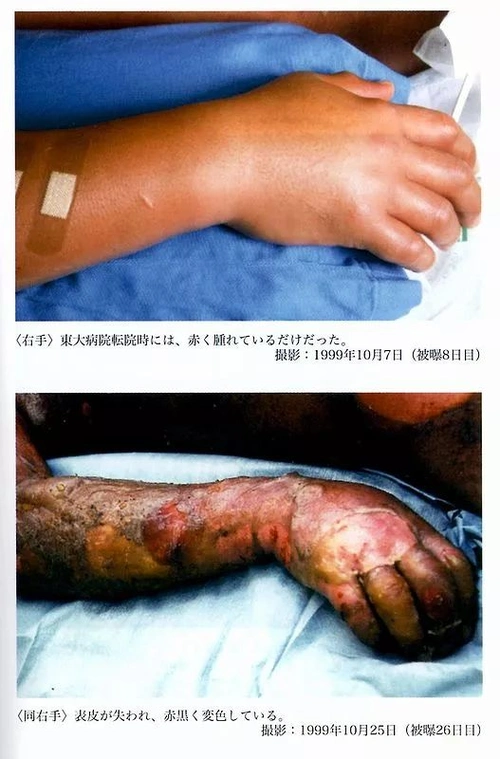 科学探秘日本严重核泄漏事件被辐射人83天身体腐烂去世