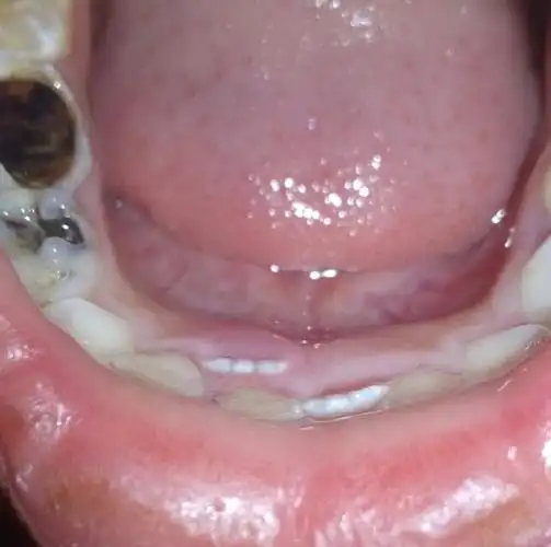 孩子刚开始换牙,下中切牙掉了一个,没掉的那个在里面长了出来,而且还