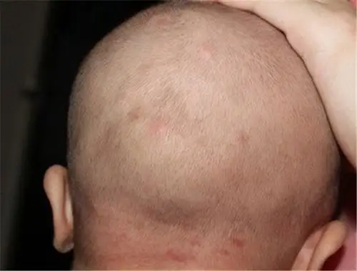 头皮毛囊炎高清图片_有来医生