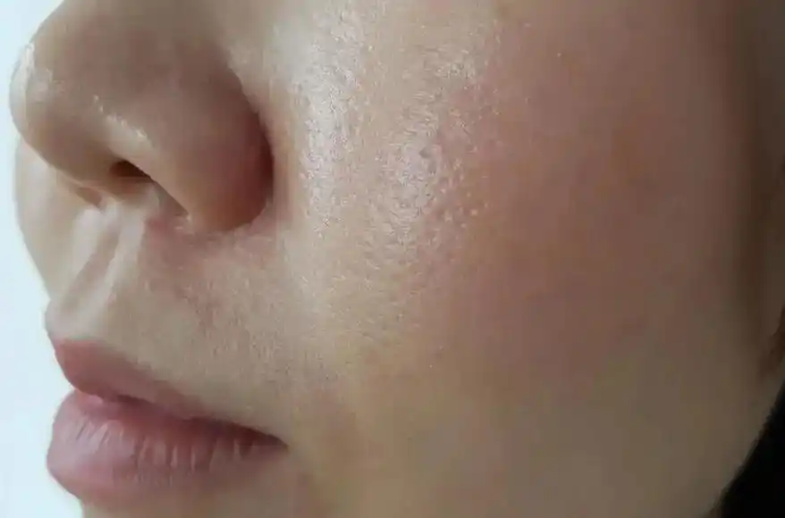 油性皮肤有什么特点?油性皮肤怎么改善?