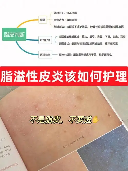 脂溢性皮炎超详细护肤攻略,拿捏啦!