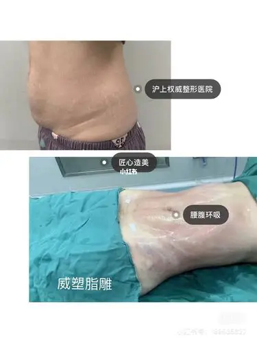 腰腹环吸