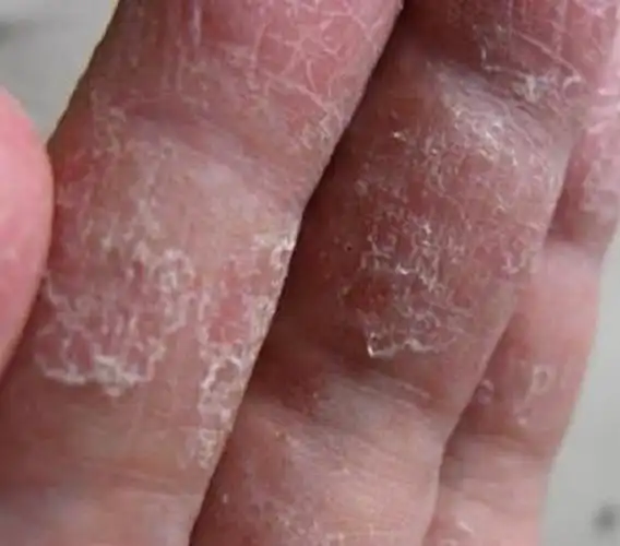 夏天一来真菌猖狂,揭开真菌性皮肤病的"真"面目