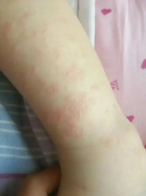 看也白看,我去儿童医院看的,药开不少,啥用没有,想想花在湿疹上的钱