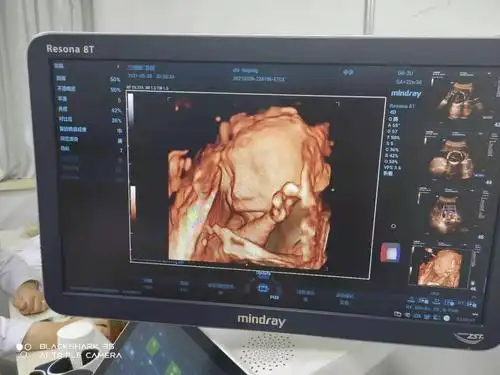 四维出来的时候发照片给我姐,她说怎么看着这么丑啊,真的很丑吗?