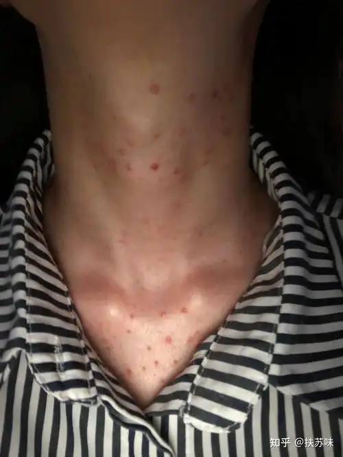 马拉色菌毛囊炎