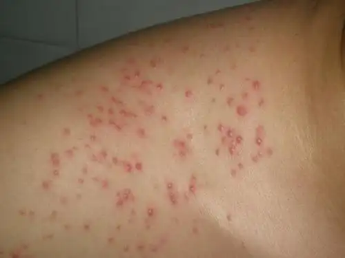 胸前起红疹丘可不一定是青春痘