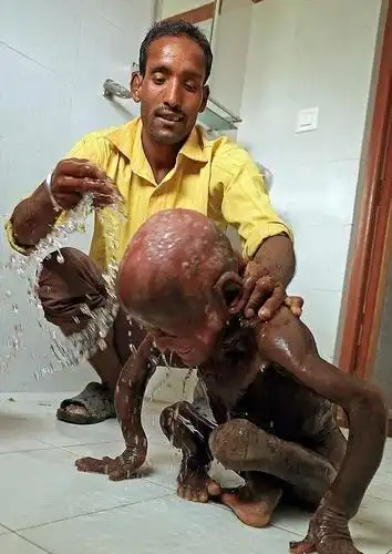 全世界不到10例11岁男孩患罕见怪病没钱医治将变石头人