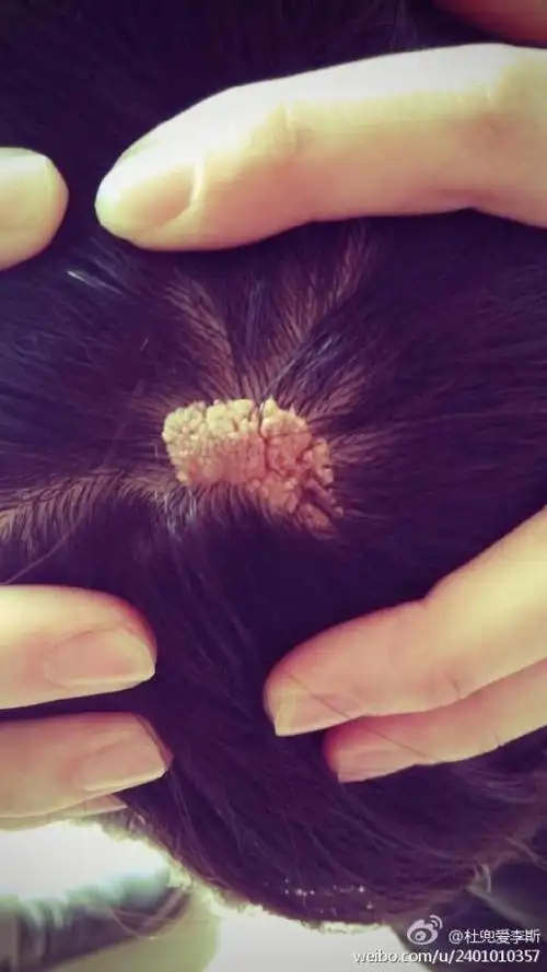 大约七岁时头上长了此