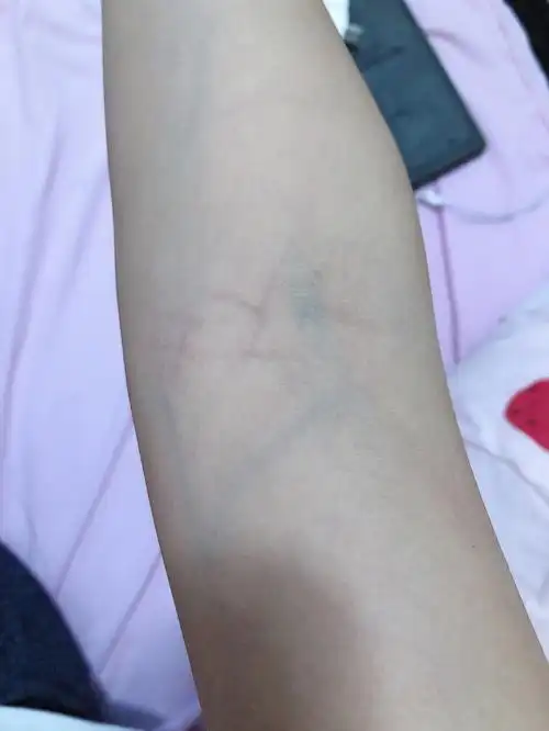 姐妹们你们的手臂血管有这样颜色的吗
