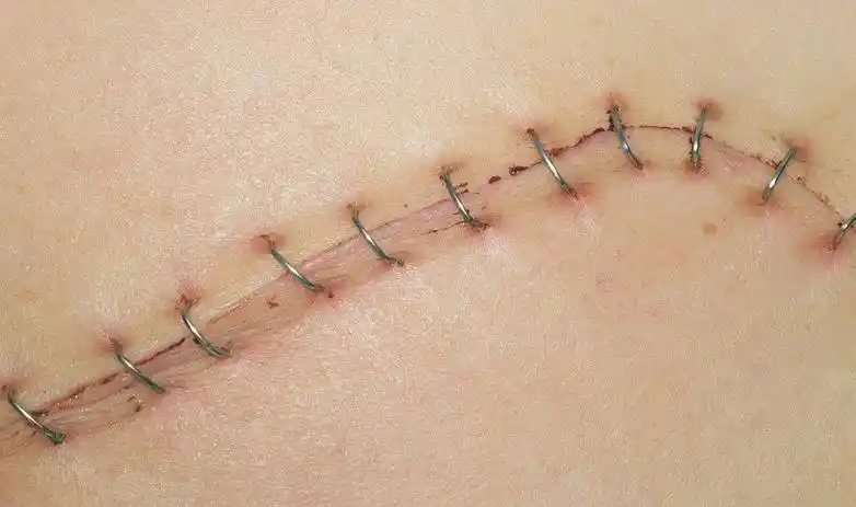 今后手术切口不用缝,用胶喷喷就可以!