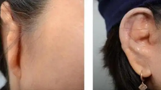 成人外耳廓畸形,还能做耳再造手术来改善吗?