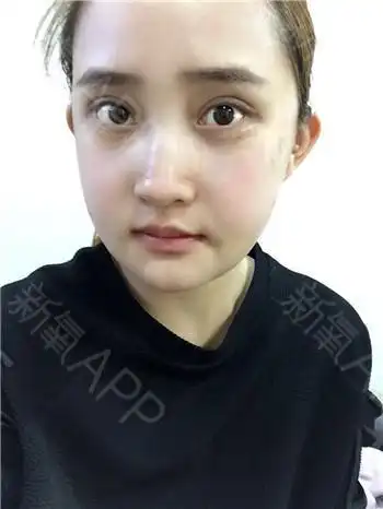 自体脂肪全脸填充好不好_效果图_gracejunk自体脂肪全脸填充术后第15