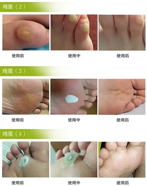 植柏诗(zhibaishi)须泡/膏/啫喱 【买2送1】去除鸡眼膏鸡眼贴日本老茧