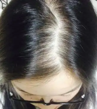 女性脂溢性脱发头发稀少,怎么变浓密?