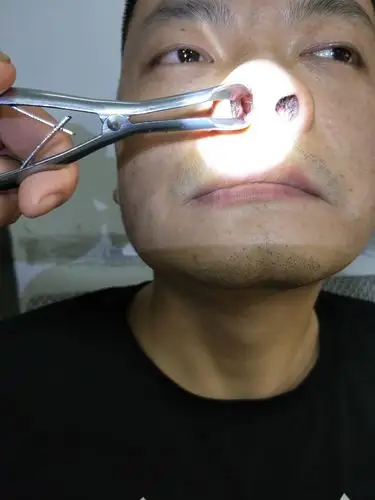 右边鼻腔缝隙相当小,无法正常呼吸!鼻黏膜轻微疱疹加轻微溃疡!