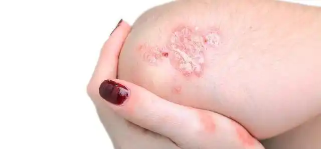 扫一扫图片识别皮肤病