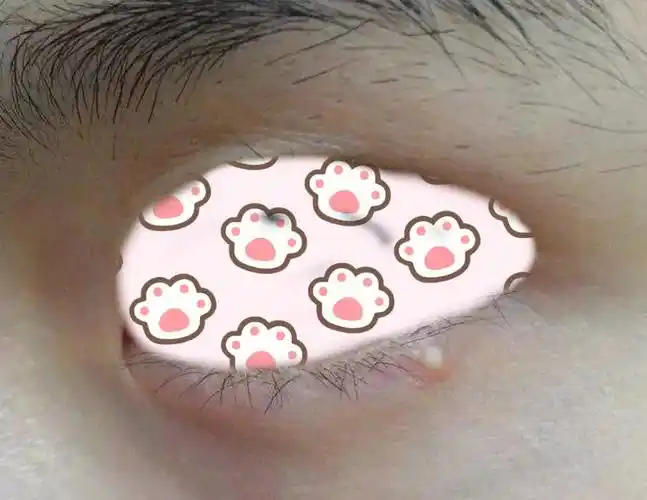 循环代谢差,吸收弱～眼部不仅会长脂肪粒,还有汗管瘤和扁平疣,很多