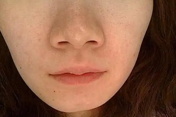 女生毛孔粗大如何改善