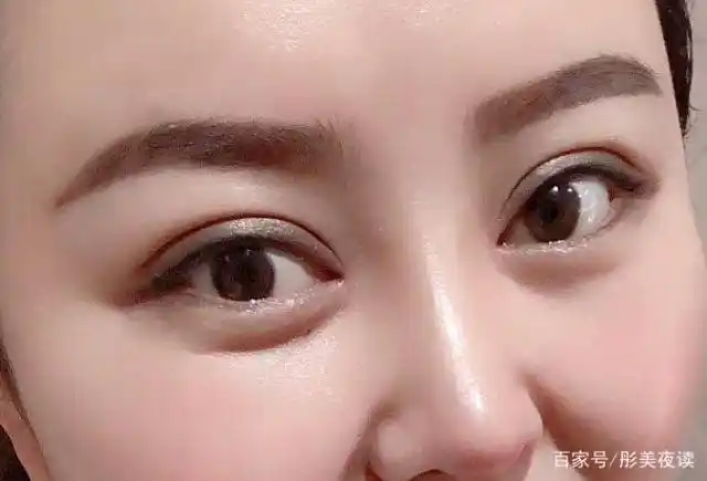 什么样的双眼皮形状最好看目前流行哪种双眼皮形态