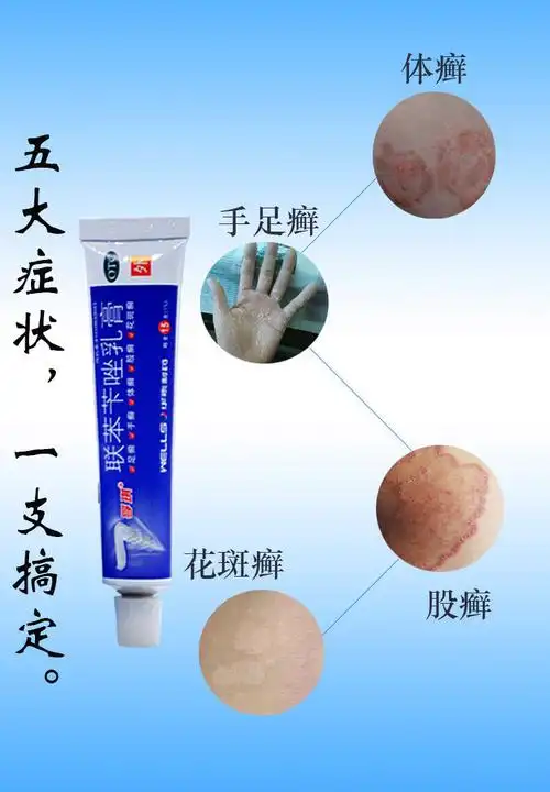 孚琪 联苯苄唑乳膏 15g 手足癣体股癣花斑癣皮肤病凝胶皮肤真菌病脚气