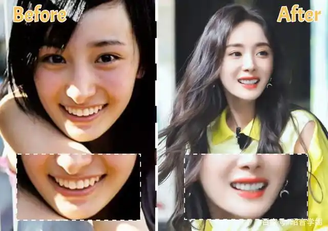 无论是凸嘴还是龅牙!原来明星靠正畸改气质
