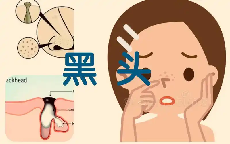 xarky黑头周而复始其实是方法根本就是错误的根除黑头从正确了解方法