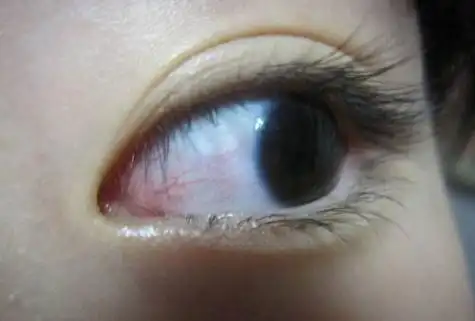 眼睛红血丝是什么病 眼睛红血丝形成的原因