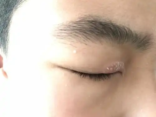 以为眼睛上的皮疹是神经性皮炎,看了医生才知道是药物过敏