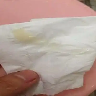 外阴瘙痒有白带怎么治