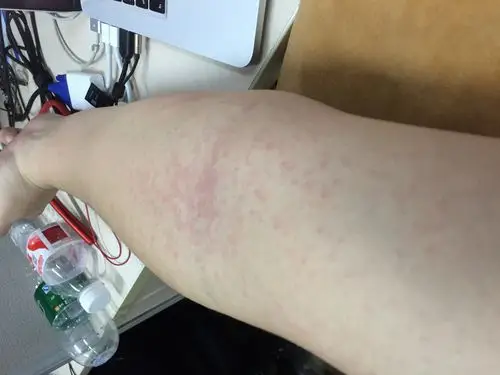 全身性质的._皮肤科_邻医网